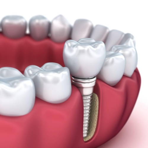 Mức giá trồng răng Implant không hề nhỏ