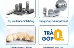 Bảng giá trồng răng Implant