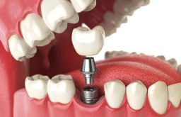 Nhược Điểm Của Trồng Răng Implant Và Những Ưu Điểm Nổi Bật