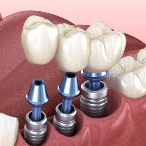 Trồng răng Implant là phương pháp tiên tiến nhất ở thời điểm hiện tại