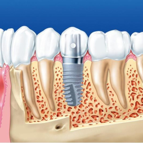 Trồng răng Implant mang lại hiệu quả cao