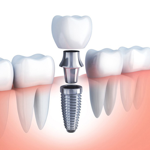 Trồng răng Implant khôi phục răng đã mất