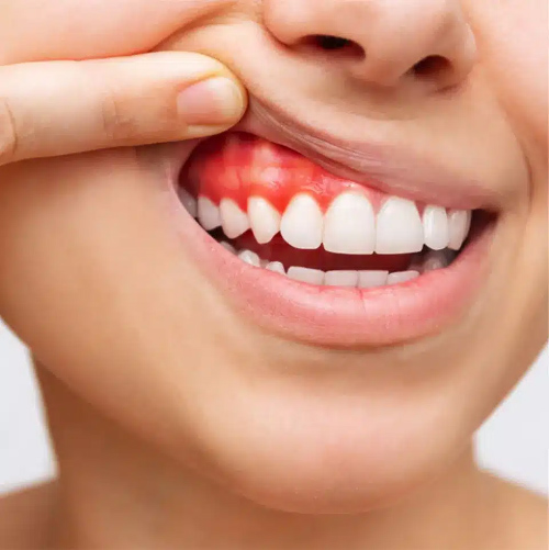 Tình trạng răng miệng ảnh hưởng tới mức giá trồng răng