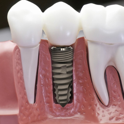 Trồng răng Implant là phương pháp phục hình hiện đại