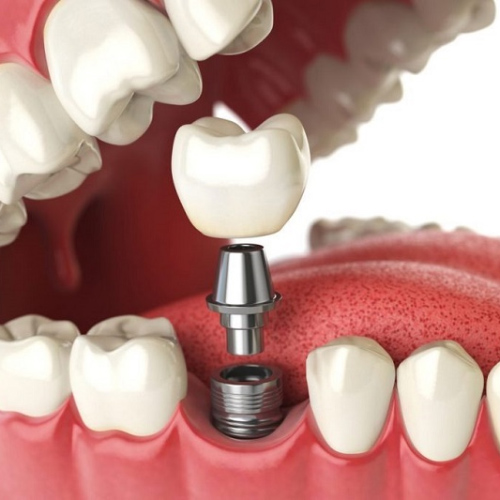Trồng răng Implant sẽ thay thế cả chân và thân răng, tạo cấu trúc vững chắc