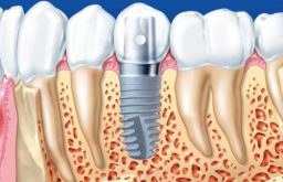 Trồng Răng Implant Có Vĩnh Viễn Không? Chuyên Gia Giải Đáp