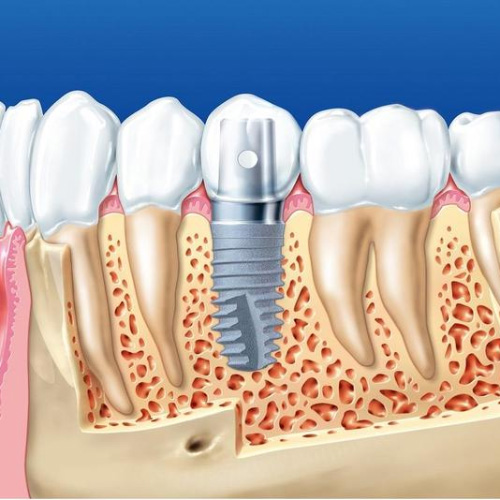 Trụ implant và mão răng sứ