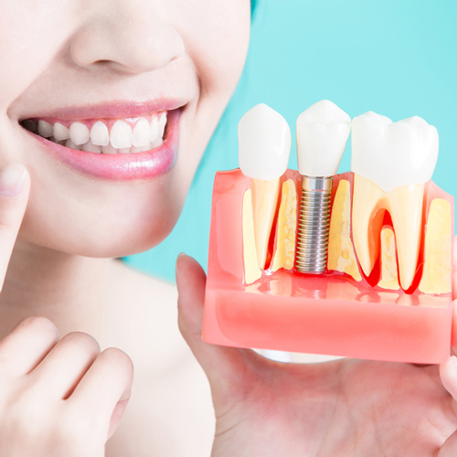 Tuân thủ những hướng dẫn từ bác sĩ để việc phục hình răng đạt kết quả tốt