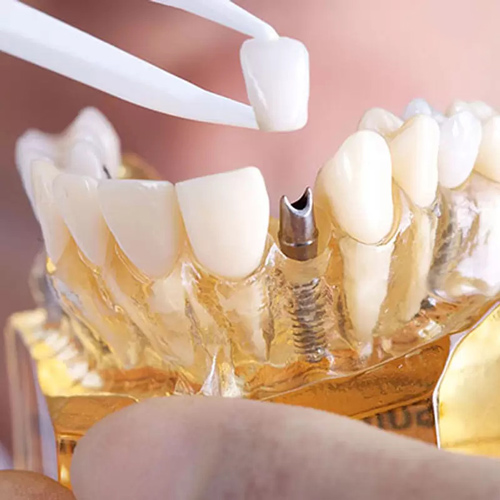 Phục hình răng sứ trên Implant là một trong những phương pháp trồng răng hiện đại bậc nhất hiện nay