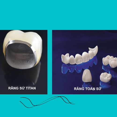 Răng sứ titan và răng toàn sứ