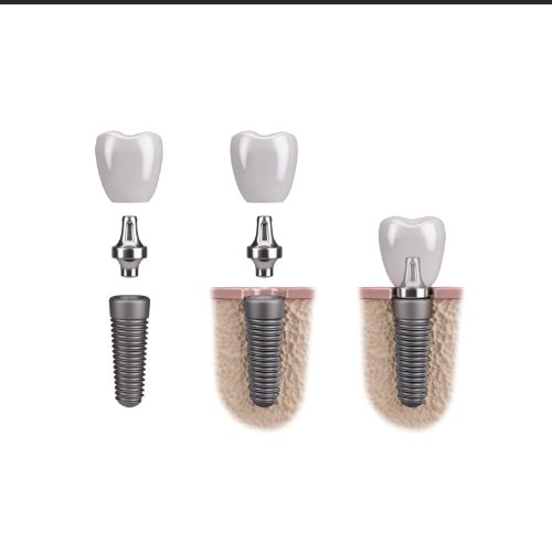 Abutment Implant là bộ phận quan trọng