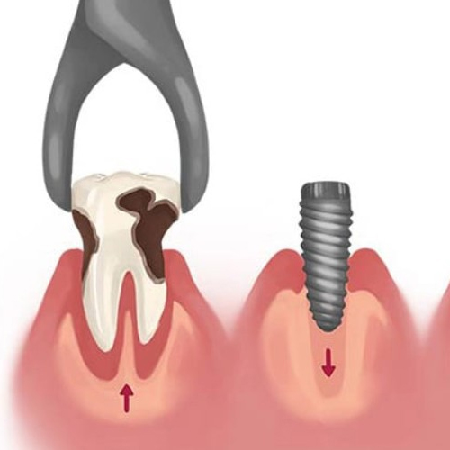 Cấy ghép Implant chịu lực tức thì là phương pháp hiện đại