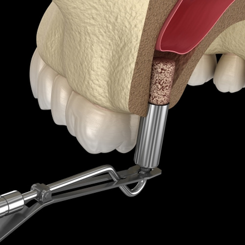 Nâng xoang để tăng chiều cao xương trước khi cấy Implant