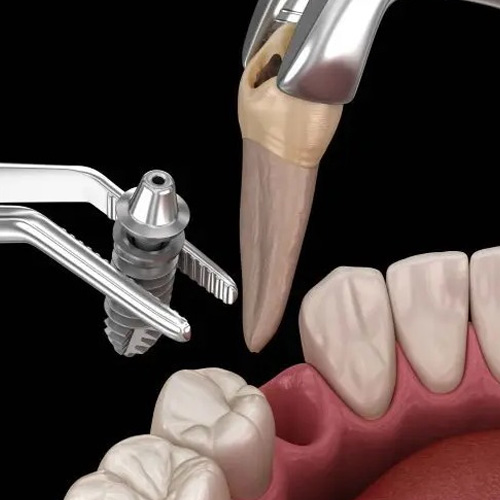 Quy trình cấy ghép implant hiện đại