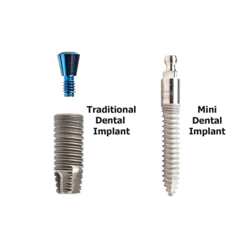 Implant thông thường với mini Implant​