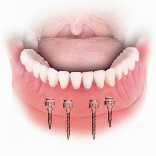 Implant mini yêu cầu kỹ thuật cao