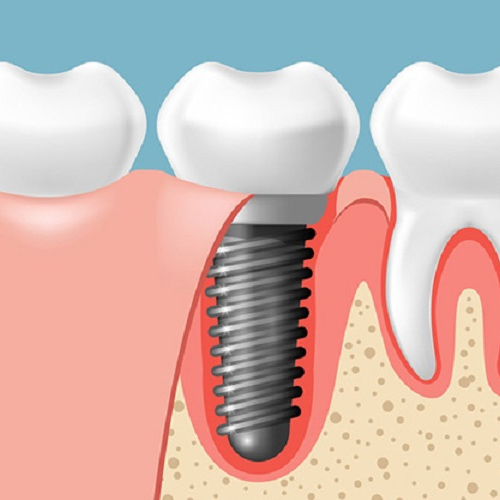 Cấy Implant không rạch lợi là một phương pháp tiên tiến