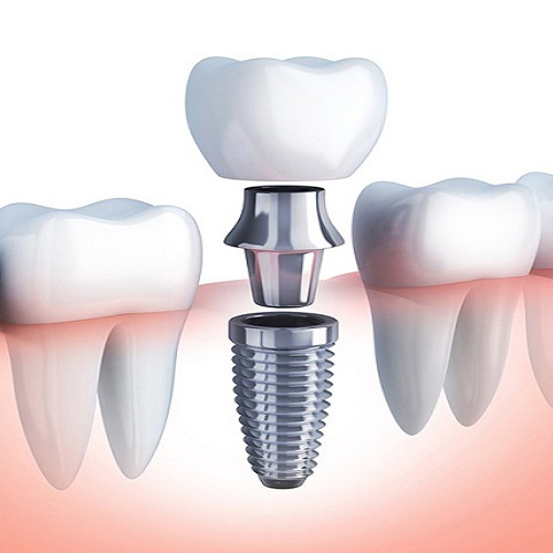 Cấy ghép Implant không rạch lợi