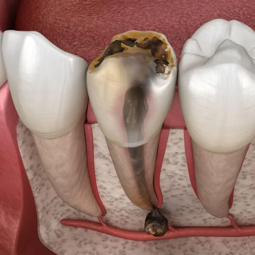 Điều trị tủy răng giúp giảm đau và khó chịu