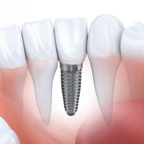 Răng lấy tuỷ có thể tồn tại từ 10 đến 25 năm