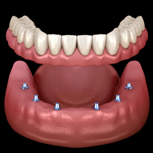 Hàm phủ trên Implant được sử dụng để thay thế răng bị mất