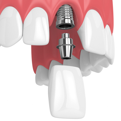 Implant răng cửa là phương pháp hiện đại