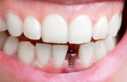 Implant Răng Cửa Là Gì? Quy Trình Và Bảng Giá Chi Tiết