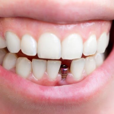 Implant Răng Cửa Là Gì? Quy Trình Và Bảng Giá Chi Tiết