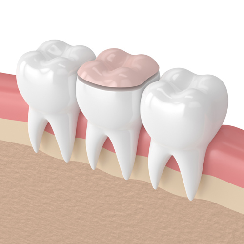 Inlay và onlay được thiết kế chính xác hơn