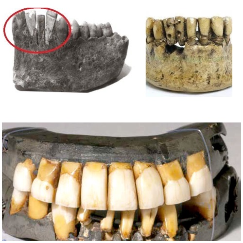 Lịch sử cấy ghép răng Implant trải qua nhiều giai đoạn