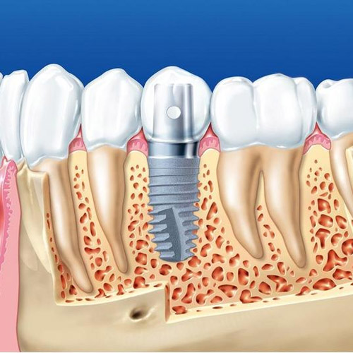 Trồng răng Implant hiện đại có những bước tiến vượt bậc