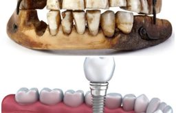 Lịch Sử Cấy Ghép Răng Implant - Các Giai Đoạn Phát Triển