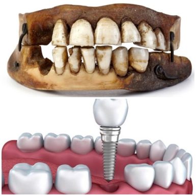 Lịch Sử Cấy Ghép Răng Implant - Các Giai Đoạn Phát Triển