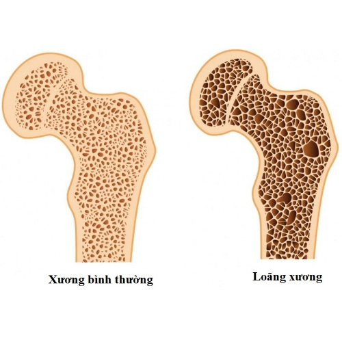 Người bị loãng xương vẫn có thể trồng Implant được