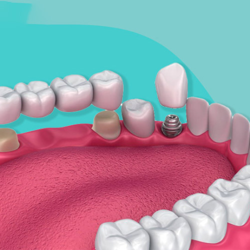 Trồng răng Implant là phương pháp hiệu quả