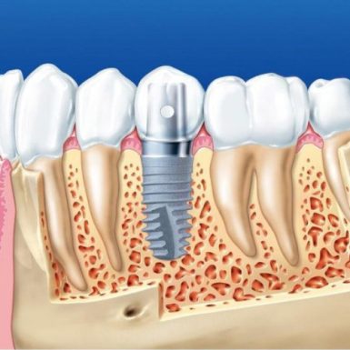 Khám Phá Lợi Ích Của Trồng Răng Implant Đối Với Sức Khỏe Răng Miệng