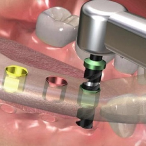 Màng hướng dẫn cấy ghép Implant