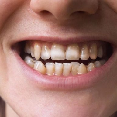 Răng nhiễm Fluor khiến men răng bị vàng, xỉn màu