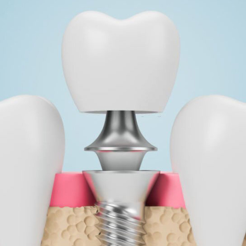 Răng tạm trên Implant được sử dụng để thay thế răng thật