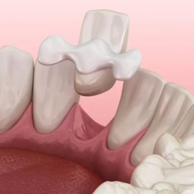 Răng Tạm Trên Implant: Tác Dụng Và Quy Trình Thực Hiện