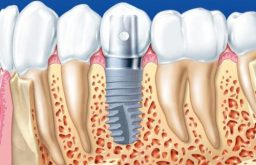 Trồng Răng Implant Bao Lâu Thì Lành? Giải Đáp Chi Tiết