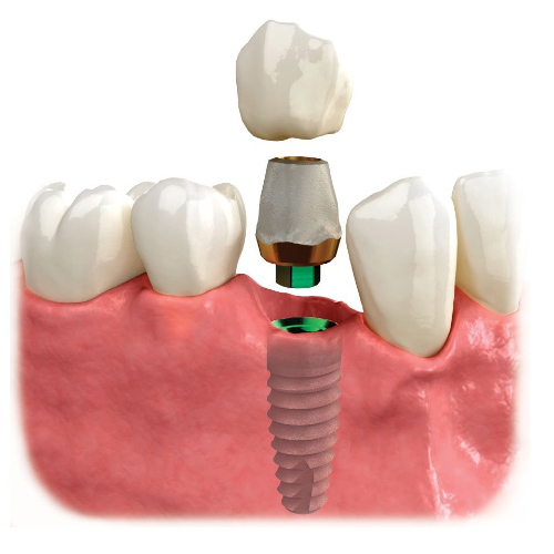 Trồng răng Implant bắt vít là một kỹ thuật tiên tiến