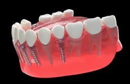 Trồng Răng Implant Bắt Vít: Quy Trình, Ưu Điểm Và Chi Phí