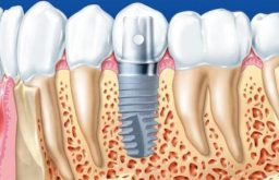 Trồng Răng Implant Có Bền Không? Yếu Tố Ảnh Hưởng
