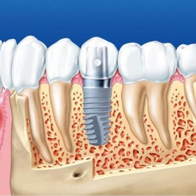 Trồng Răng Implant Có Bền Không? Yếu Tố Ảnh Hưởng