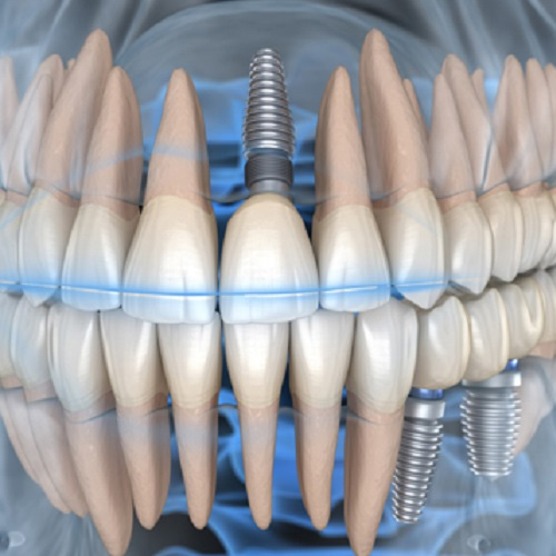 Trồng răng Implant vân có thể chụp MRI