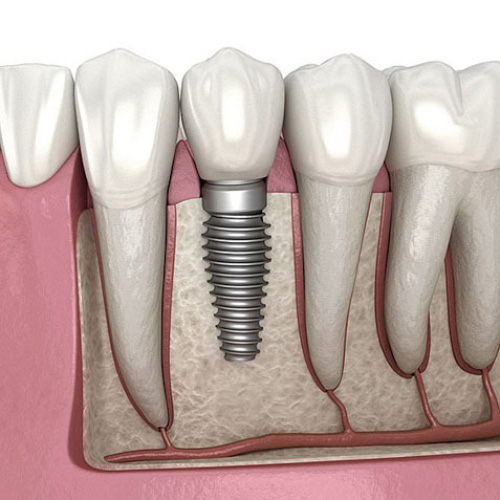 Trồng răng Implant hoàn toàn có thể đi máy bay