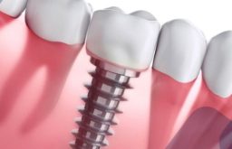 Trồng Răng Implant Có Gây Dị Ứng Không? Chuyên Gia Giải Đáp