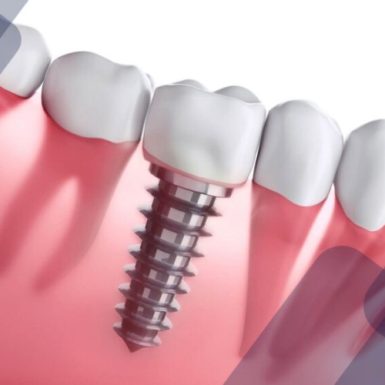 Trồng Răng Implant Có Gây Dị Ứng Không? Chuyên Gia Giải Đáp