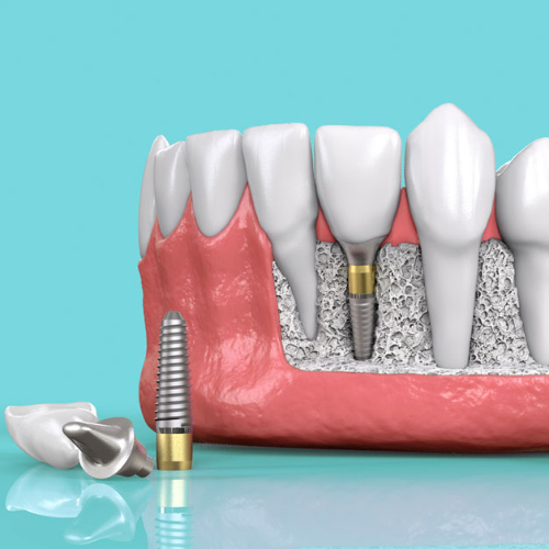 Trồng răng Implant có tuổi thọ khoảng 25 năm